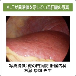 ALTが異常値を示している肝臓の写真